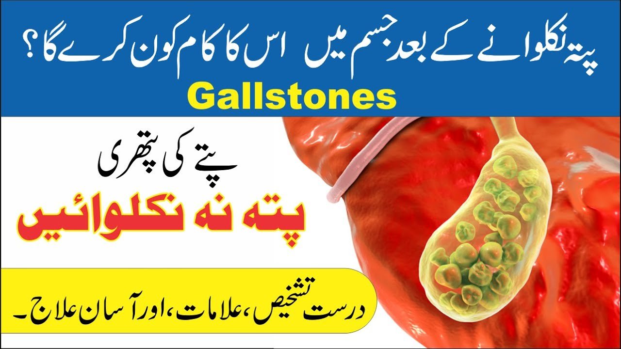 Gallstones